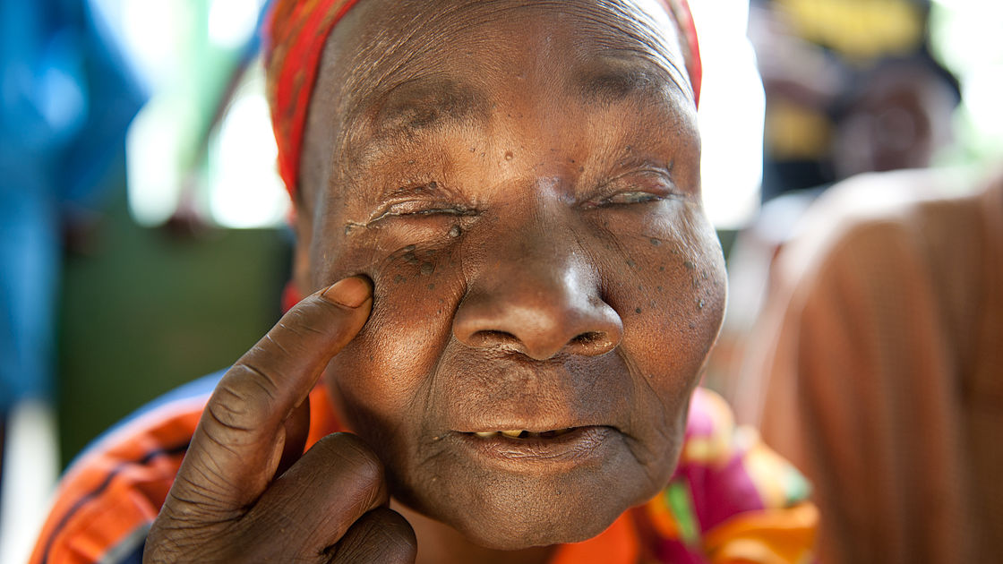 Mary is pointing to her eyes. She was diagnosed with trachoma.
